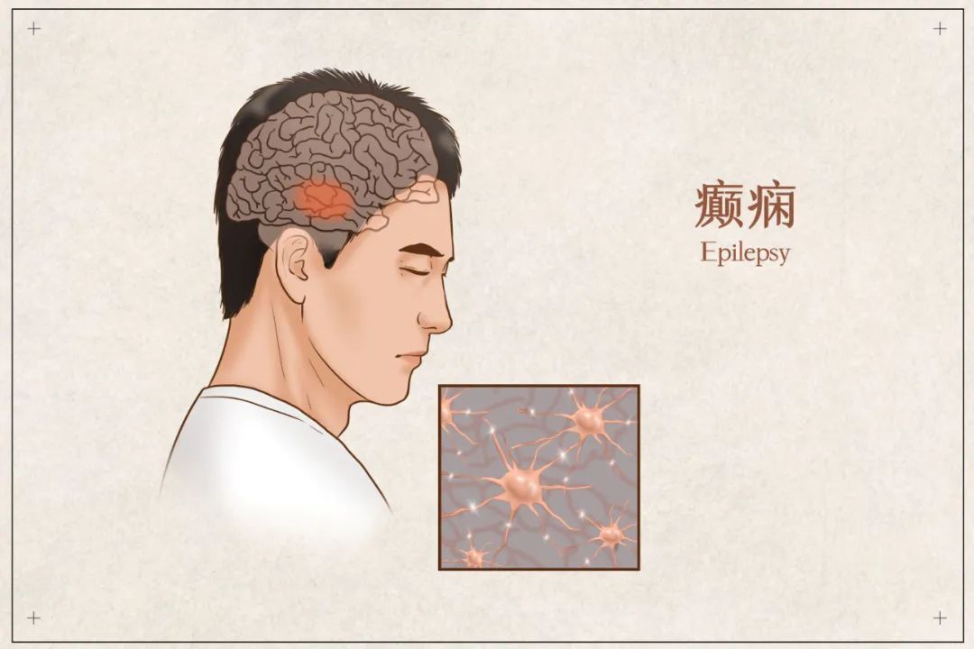 “恶灵附身”还是脑部疾病？对癫痫的误解简直不要太多