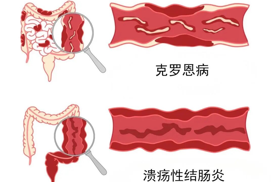 世界炎症性肠病日｜反复腹泻且感觉排便不舒畅，你可能患了这种病……