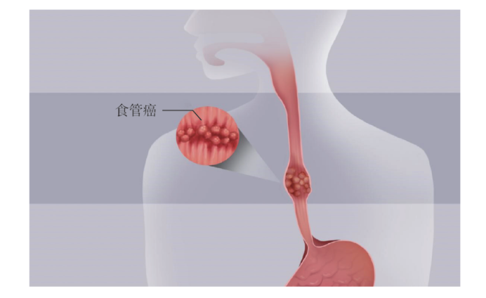 吞咽困难、声音嘶哑有可能是食管癌？