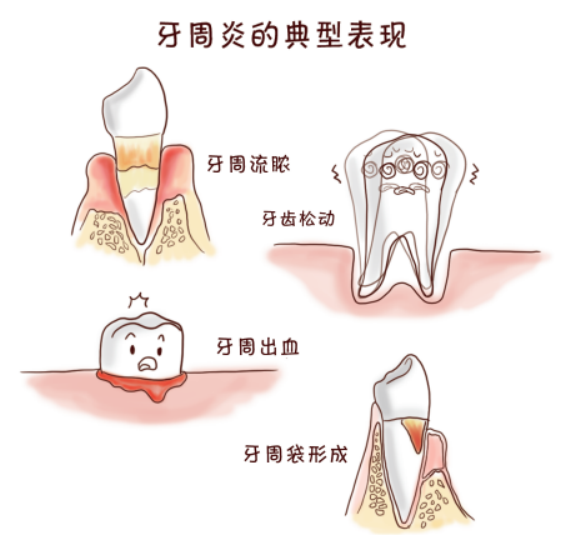 牙周炎会让牙齿都掉光吗？