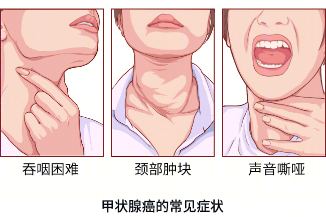 甲状腺出现这个问题，可能是手术预警