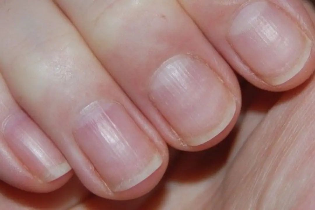 Nail ridges: an expert shares causes & how to treat – Scratch