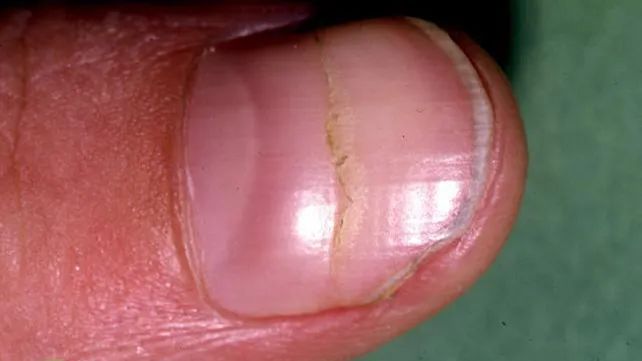 Ridges in Fingernails: Symptoms, Causes, and Treatments
