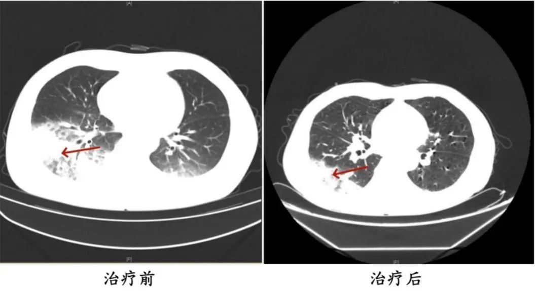 吹了3天空调，男子左肺“白”了一半！专家紧急提醒