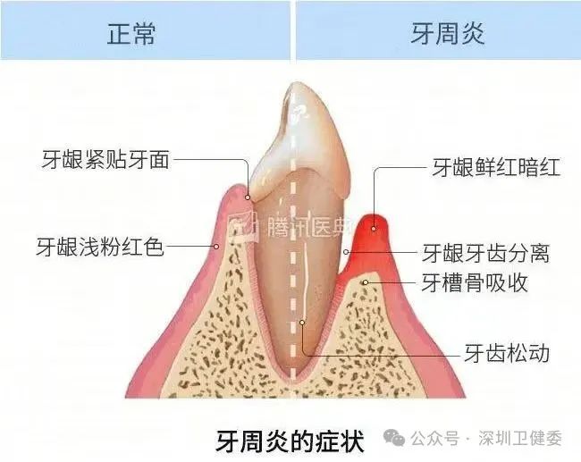 牙齿感染能闯多大祸？看完惊呆了！