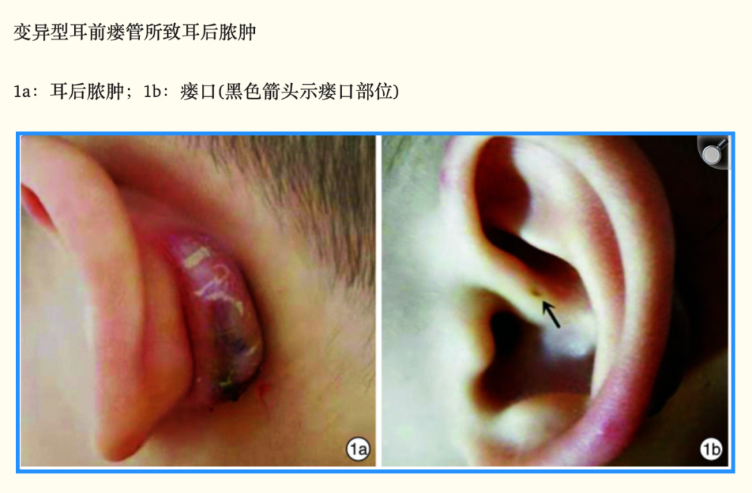可怕！耳朵上的这个小洞，可能是个不定时炸弹……