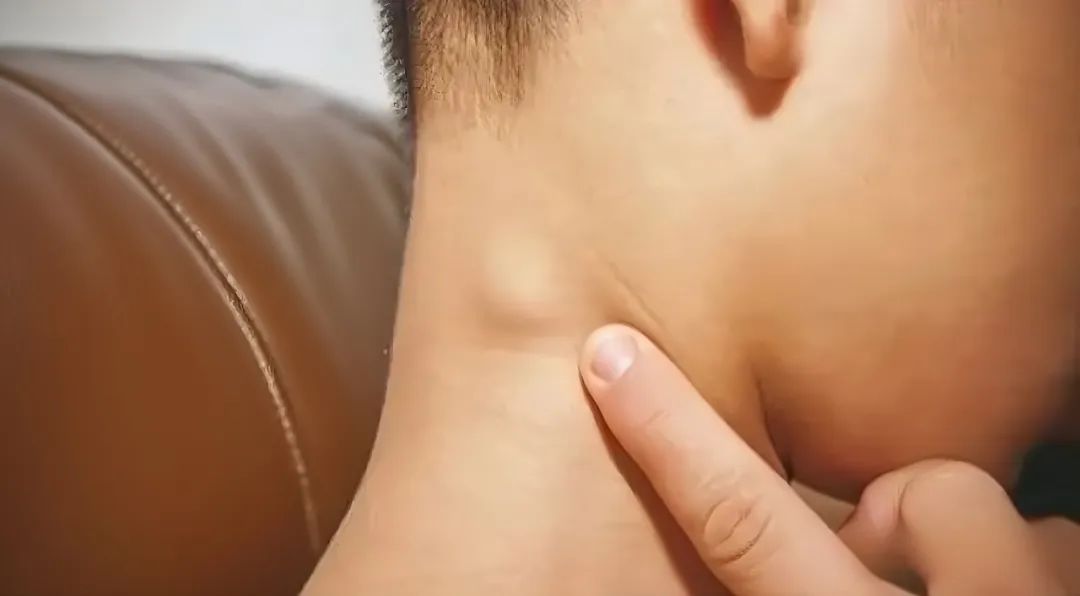 5岁男孩确诊癌症晚期！别忽视身上这种“小疙瘩”，很多人都有！