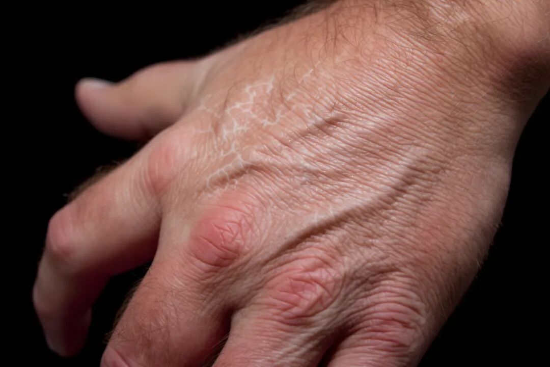 这样洗澡当心越洗越痒！防手足皲裂必看→