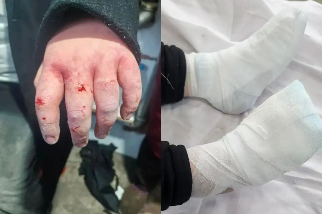 大学生雪地里摔晕后，3根手指或面临截肢