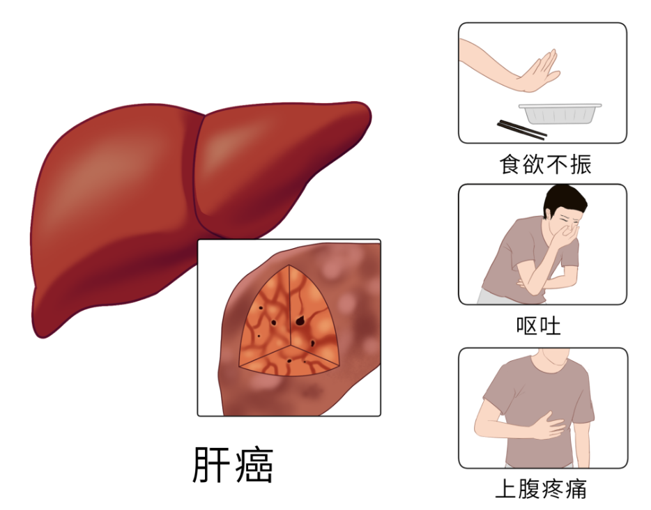 为什么肝癌一发现就是晚期？