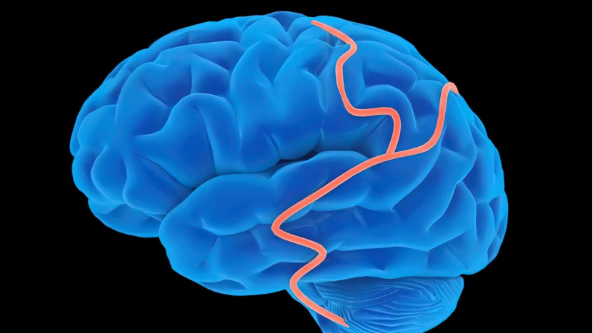 绕过血脑屏障！微创新方法让药物直达脑卒中病灶