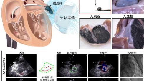 磁流体左心耳封堵术问世，房颤治疗迎来中国新方案