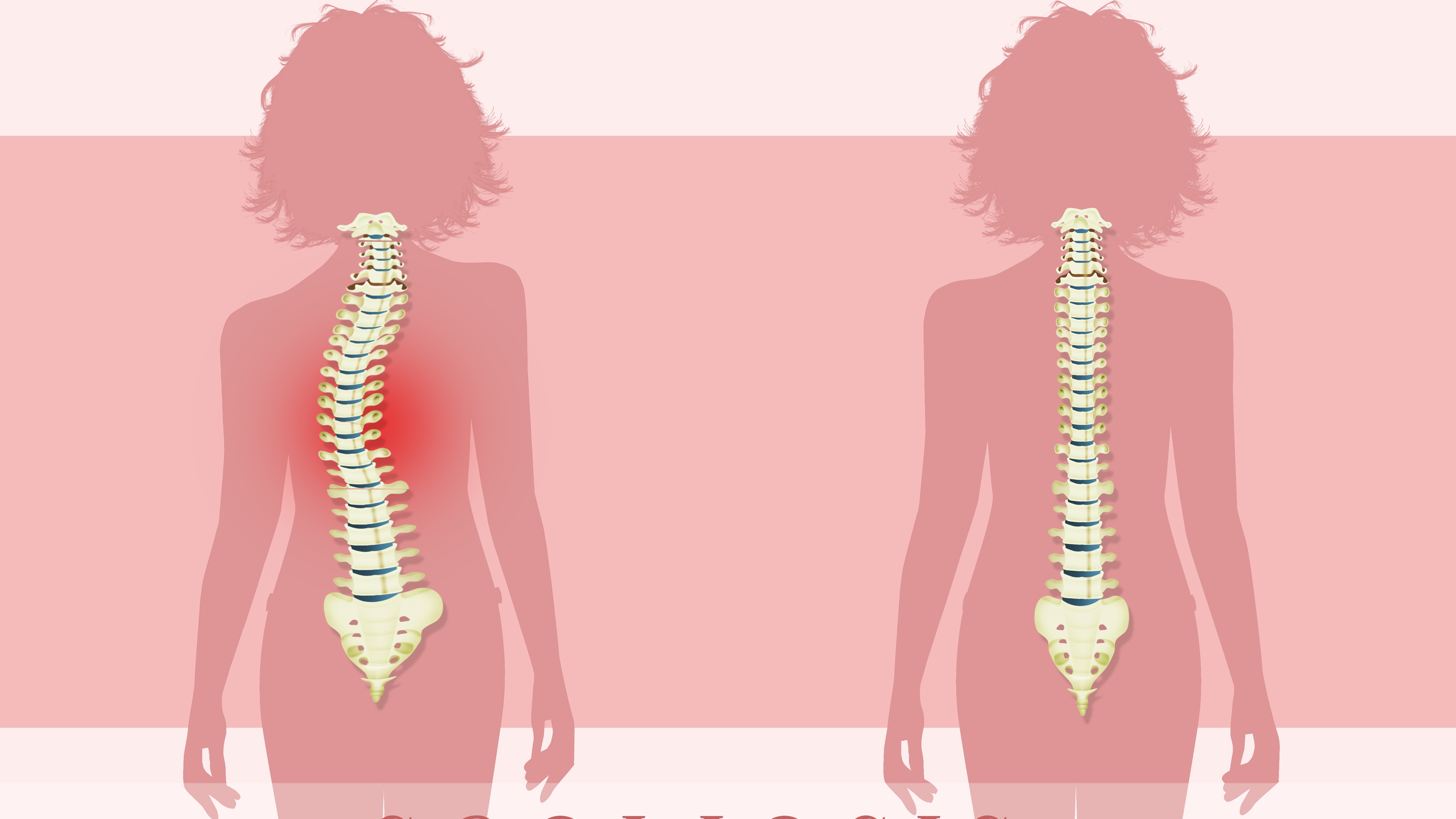 中西医结合护脊柱，让孩子少走 “弯” 路