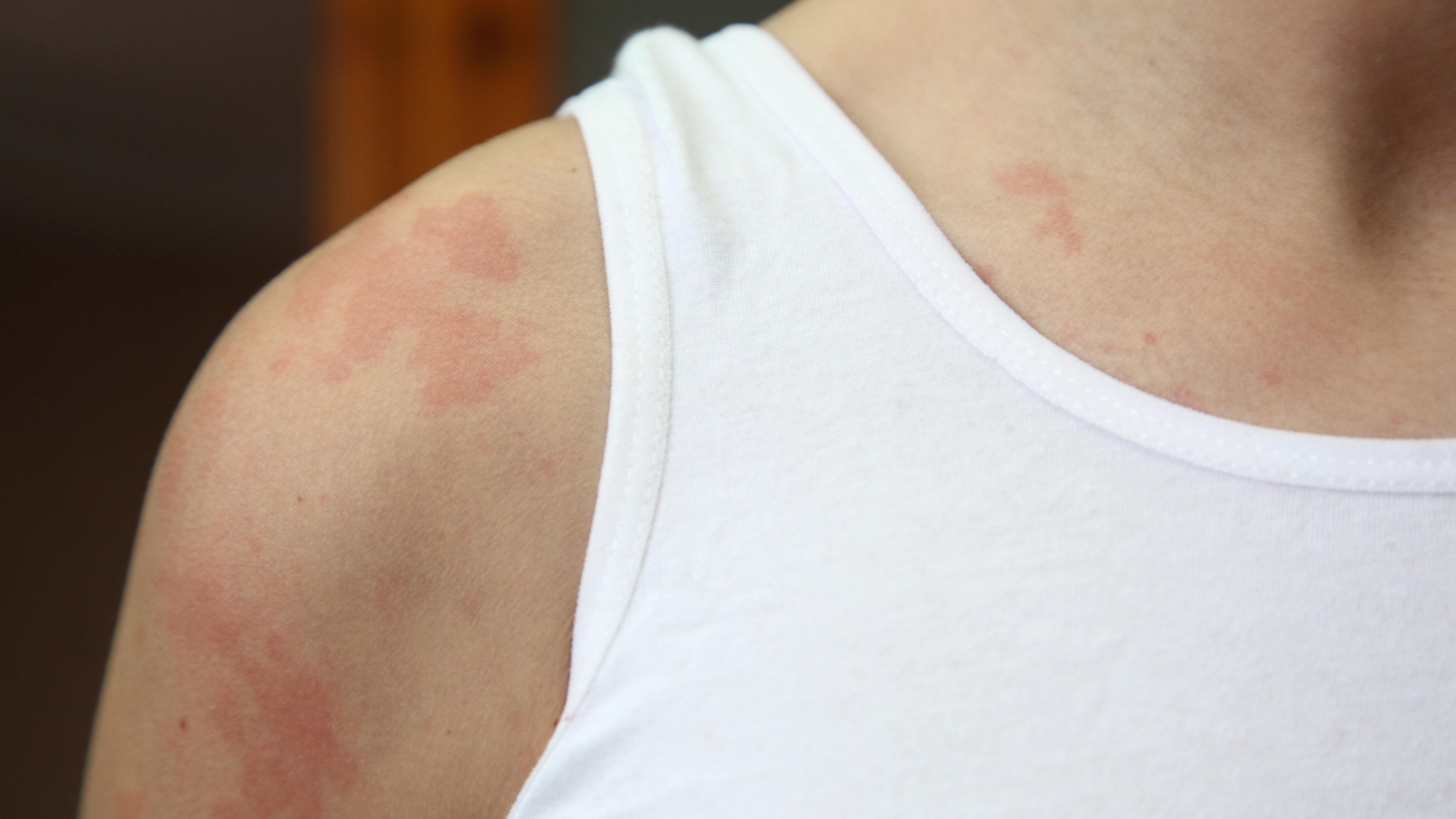 春季晒后又红又痒？光敏性皮炎了解一下