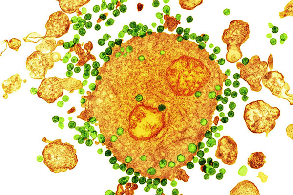 Second Patient In History Has Been Cured Of HIV