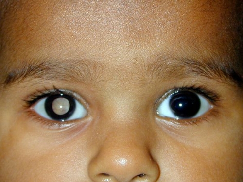 Retinoblastoma in right eye（aravind.org）