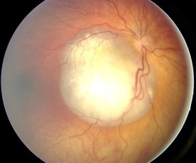 Ocular fundus aspect of retinoblastoma (Wikipedia)