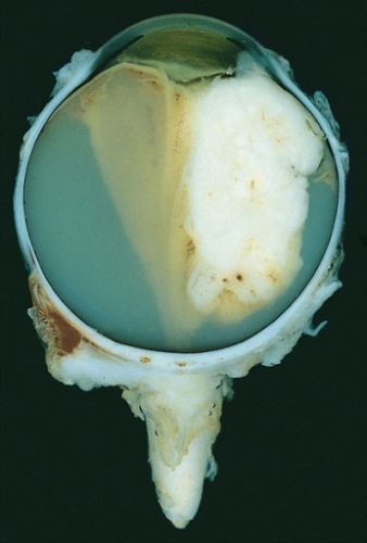 Large exophytic white tumor with foci of calcification producing total exudative retinal detachment (Wikipedia)