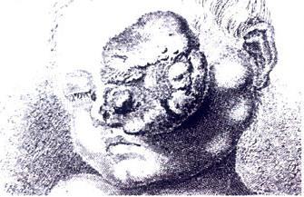 Drawing of a large retinoblastoma from 19th Century (Wikipedia)
