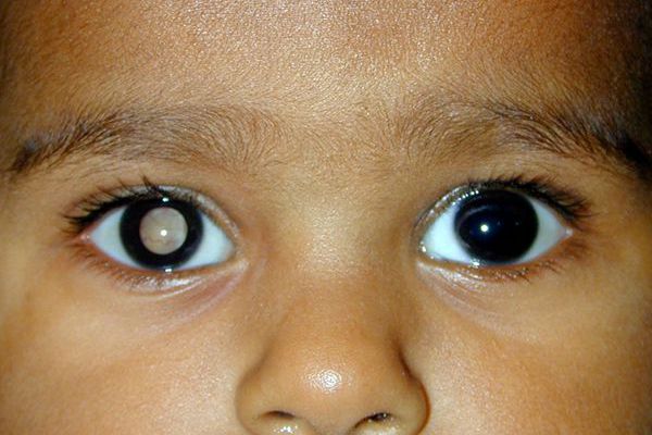 Retinoblastoma: the discovery of a darkling gene