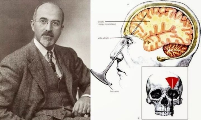 弗里曼医生和他发明的脑前额叶切除术.