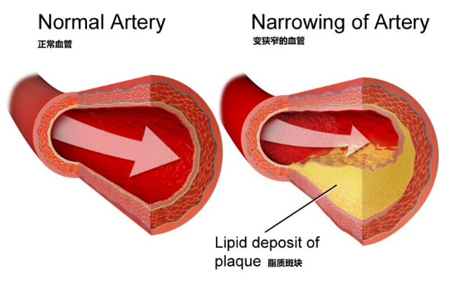 胆固醇引起动脉粥样硬化,图片来源:flickr