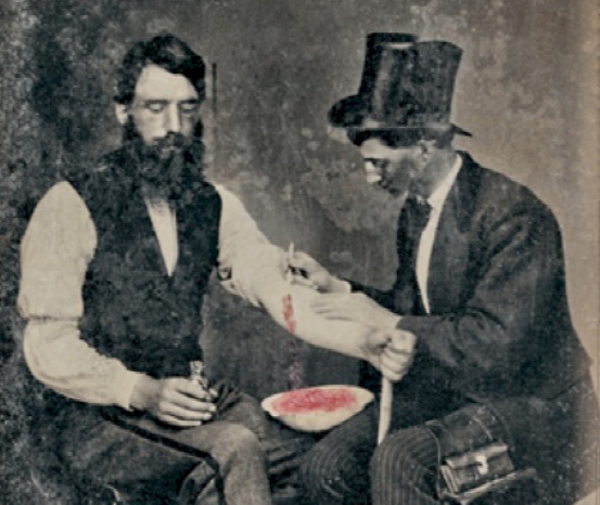 1860年的放血手术，图片来源wikipedia