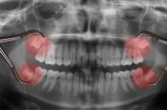 Can the Extracted Wisdom Teeth Still be Used on Yourself?