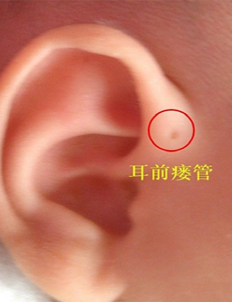 有耳仓的宝宝真的会富贵聪明吃穿不愁吗