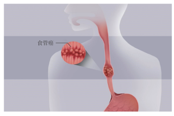 “趁热吃”会导致食管癌？
