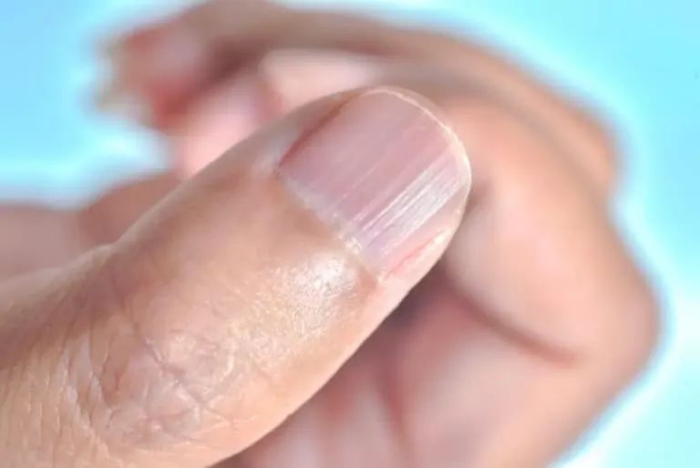Ridges in Fingernails: Causes and Treatments - Riverchase Dermatology