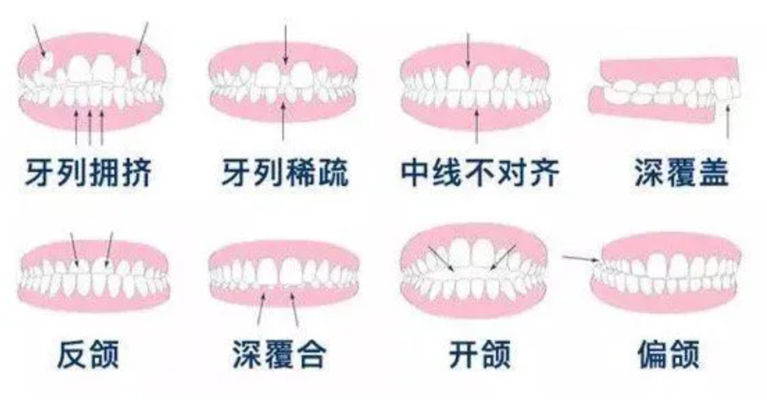 30 岁了，还能矫正牙齿吗？