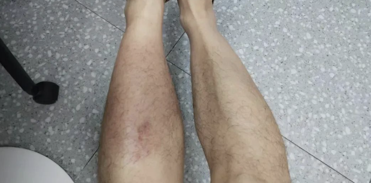 雨天一个动作，男子竟染上这种病