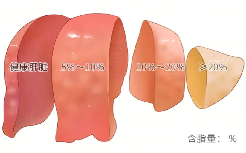 得了脂肪肝，就要吃保肝药……是真是假？