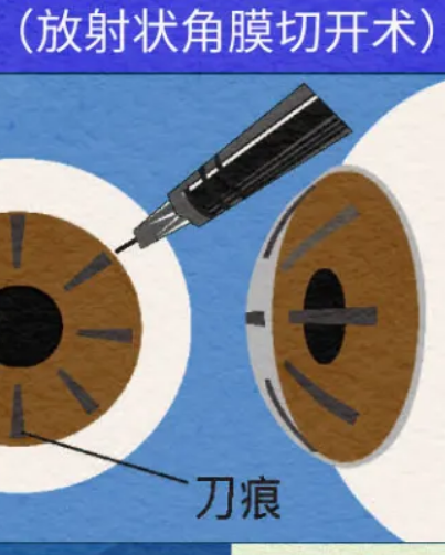 那些做近视手术的人，付出了什么代价吗？有什么后遗症吗？