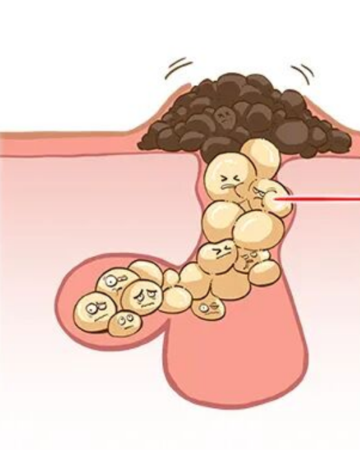 增生、息肉、结节、囊肿……会变癌吗？