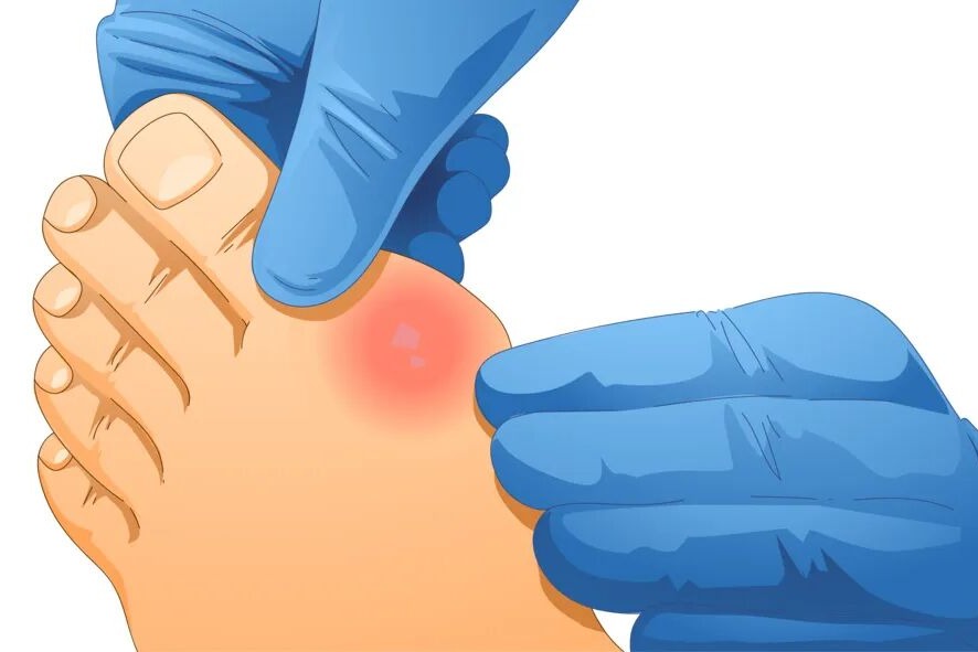 到底是“肾不好”引起血尿酸升高，还是血尿酸升高引起“肾不好”？