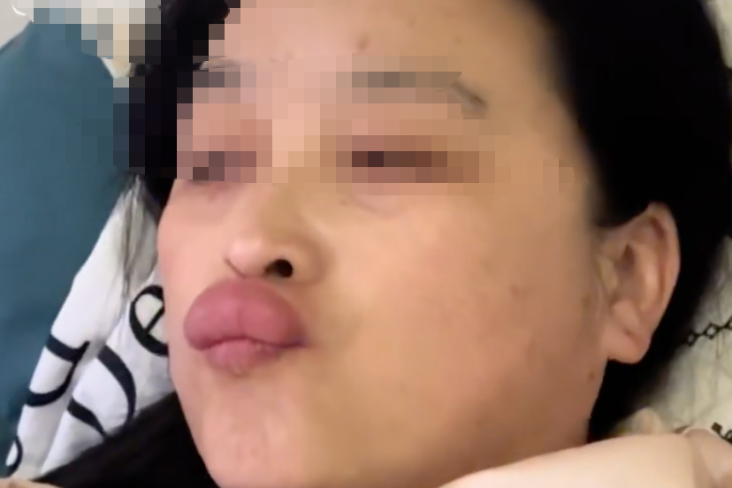 亲吻婴儿脚丫后，嘴唇红肿如香肠！医生提醒......