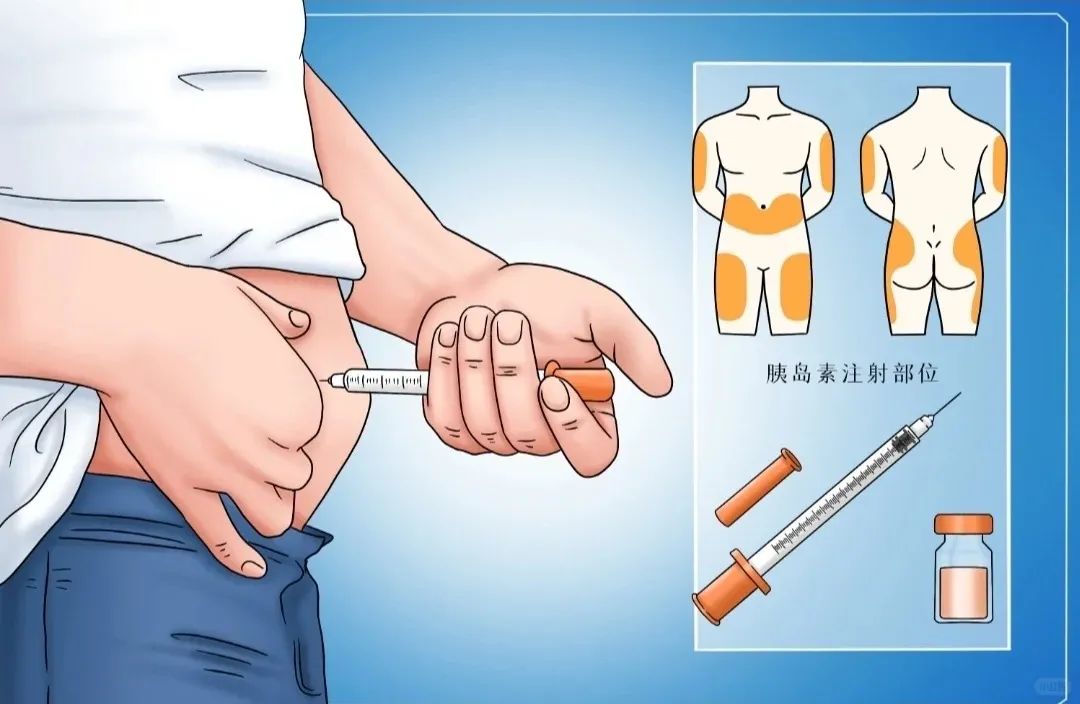 得了糖尿病，打胰岛素比吃口服药效果好?