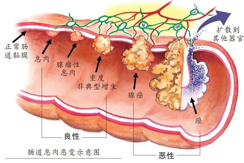 体检发现肠息肉要切吗？这种几乎100%会癌变