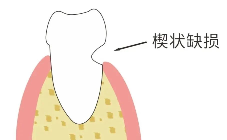 想不到！肥胖、超重伤牙齿，牙周炎会致冠心病……