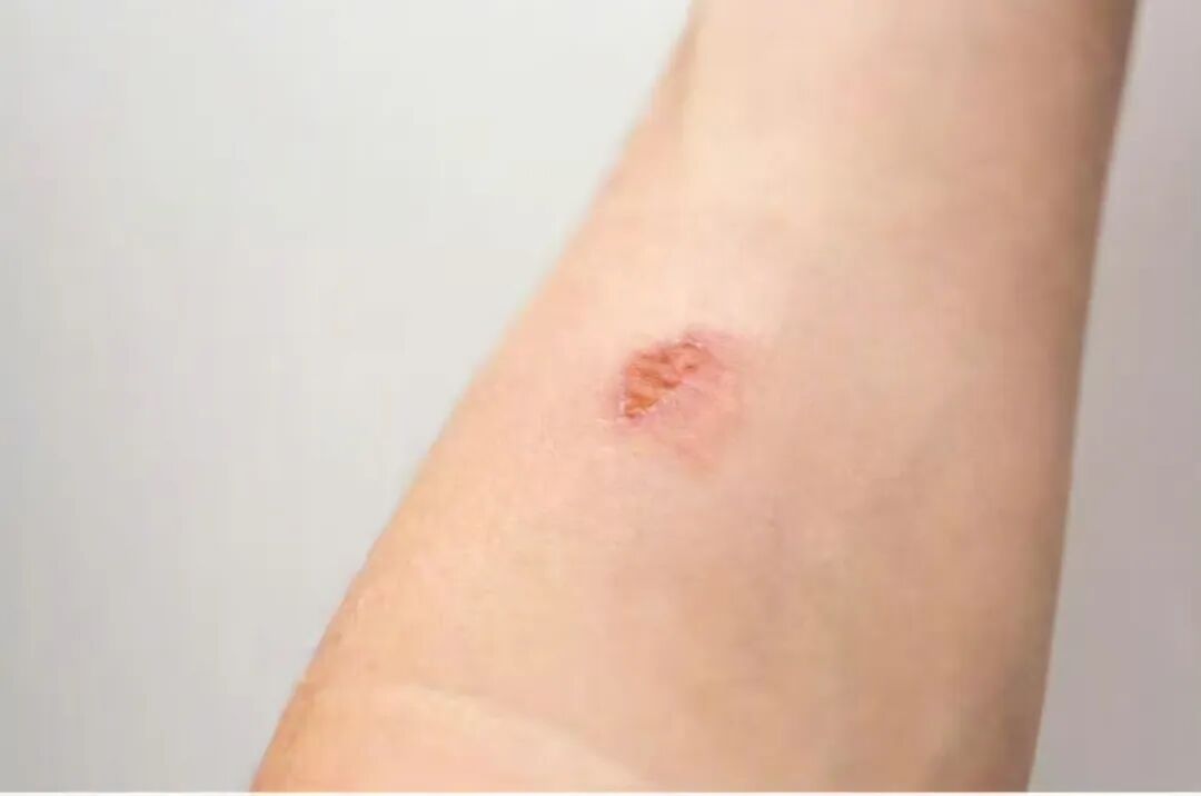 红霉素软膏真能治一切？这5种情况涂了等于找罪受！