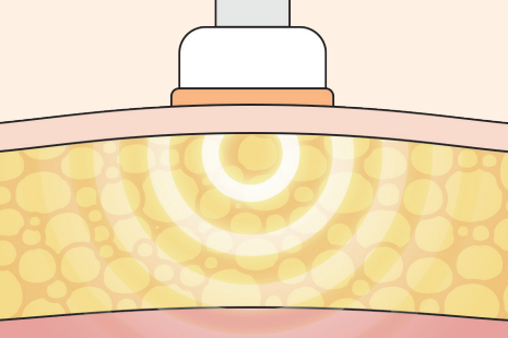 医美“躺瘦”是智商税吗？