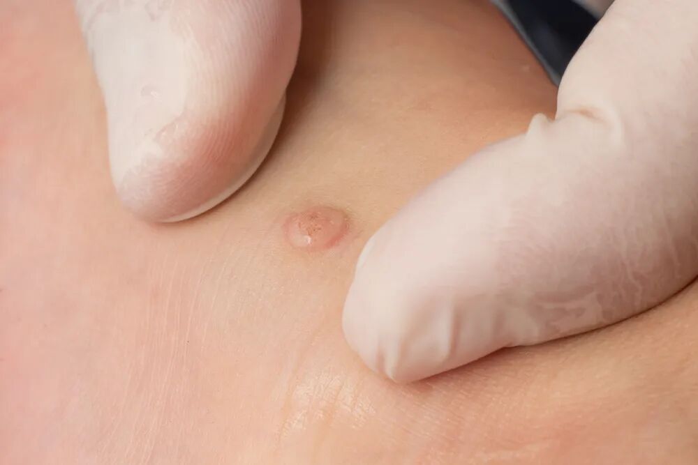 身上长的这四种小疙瘩，与HPV感染有关，皮肤破损时尤其要注意！