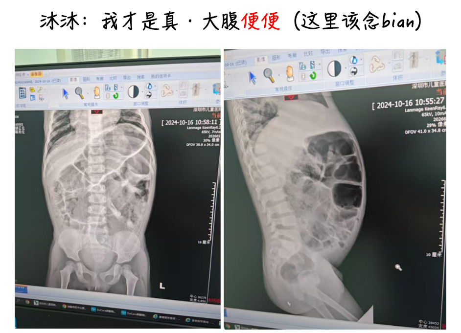 天生没肛门，“我儿子用小鸡鸡拉屎，拉了5年”