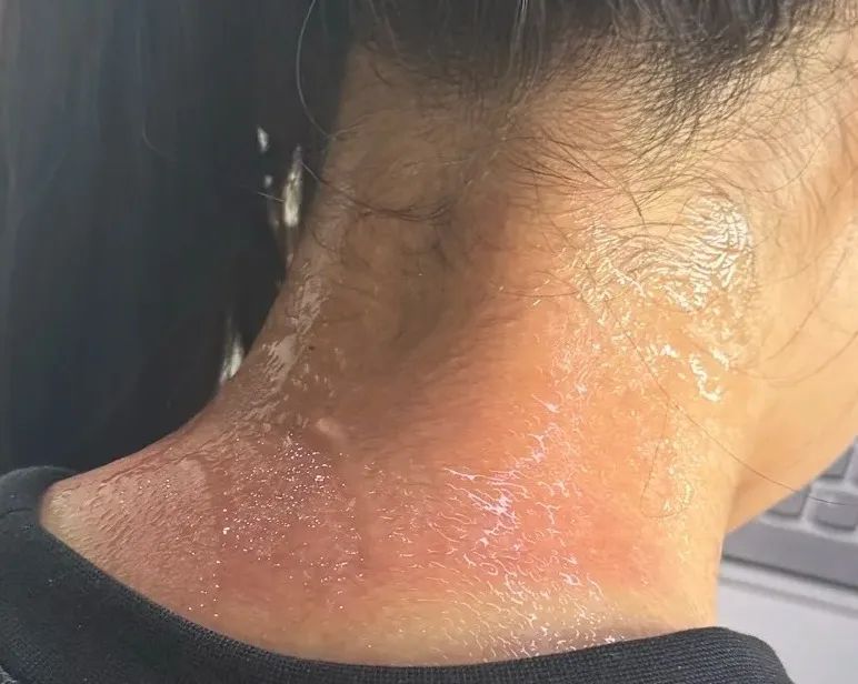 除了脸，还有一个地方也要记得涂防晒