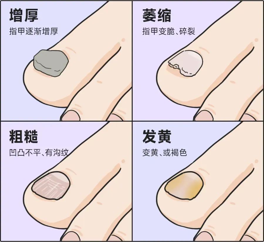 指甲出现这几种情况，竟也是灰指甲！很多人却不知道