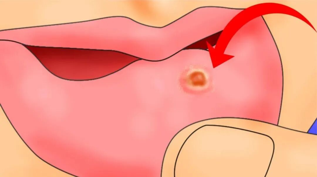 口腔溃疡有5个特征，要警惕癌变风险