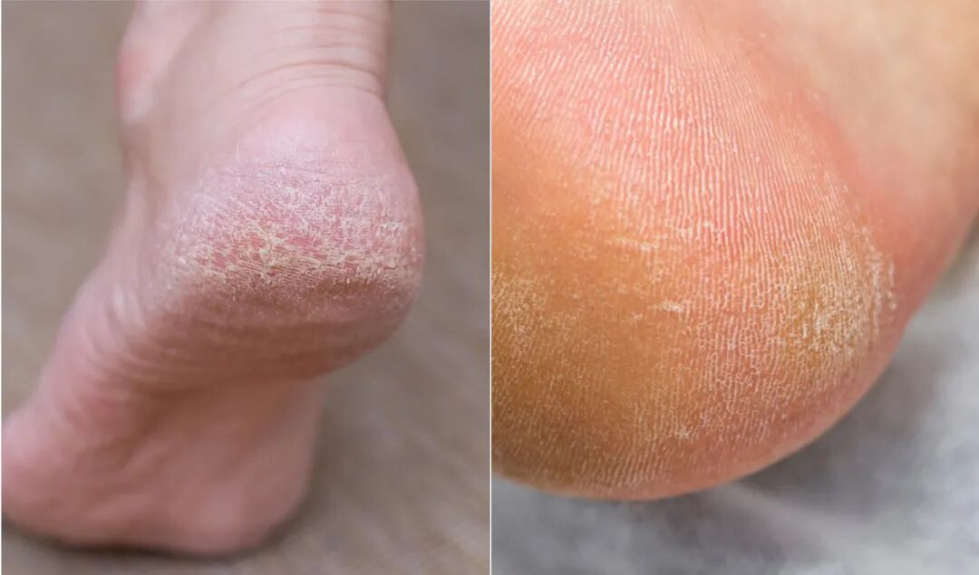脚后跟开裂起皮，小心一种皮肤病！可能不只是干