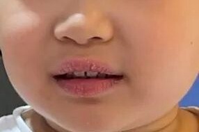 孩子嘴唇干裂、起皮……小心是这种疾病